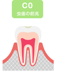 c0 虫歯の前兆