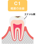 c1 軽度の虫歯