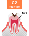 c2 中度の虫歯