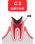 c3 重度の虫歯