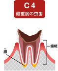 c4 最重度の虫歯