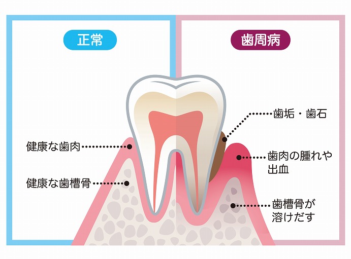 歯周病とは？